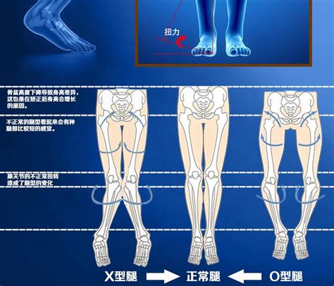 外八字走路|走路外八字怎么矫正